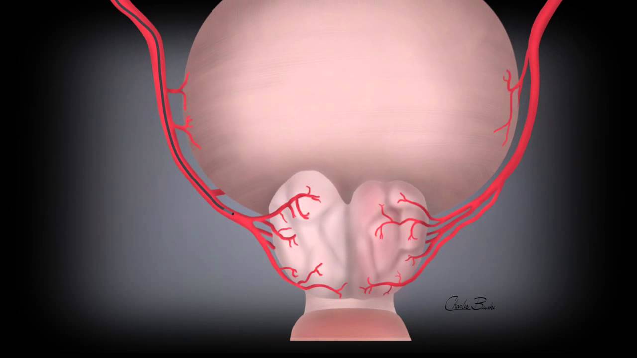 New BPH Treatment for enlarged prostate: Prostatic Artery ...