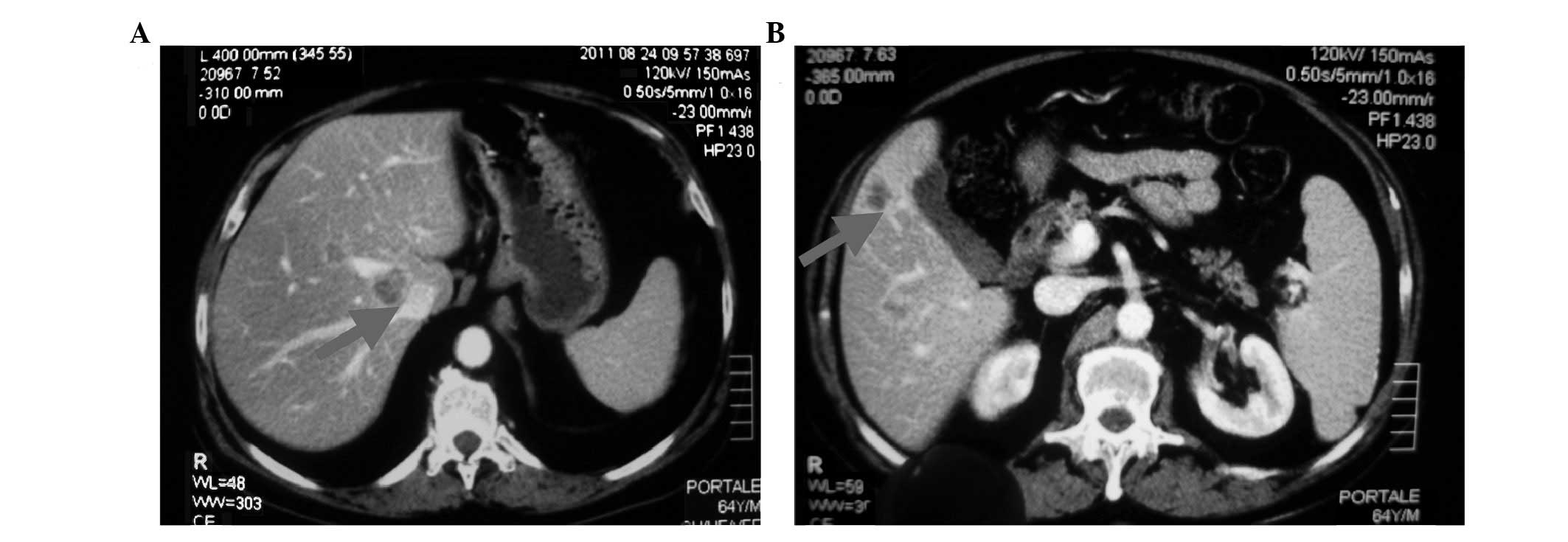 Partial response of liver metastases treated with abiraterone in ...