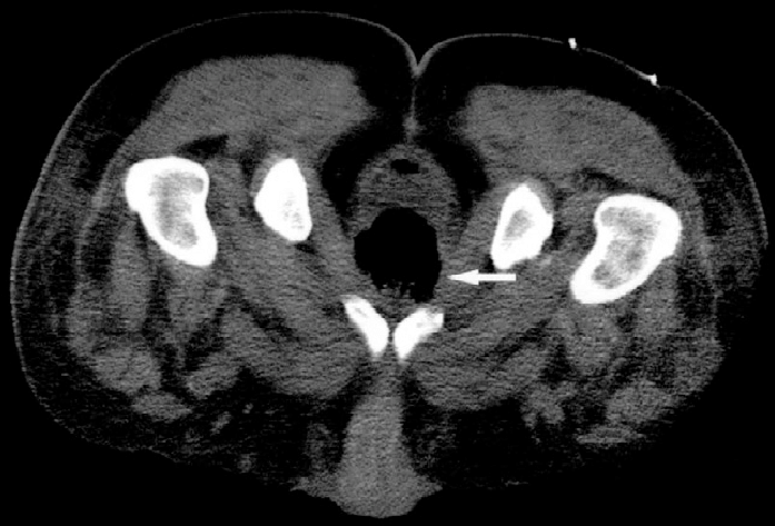 Pelvic computed tomography demonstrates an enlarged ...