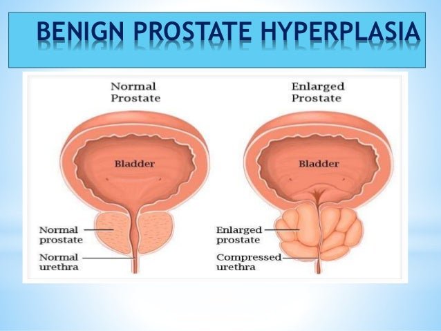 Presentation enlarged prostate