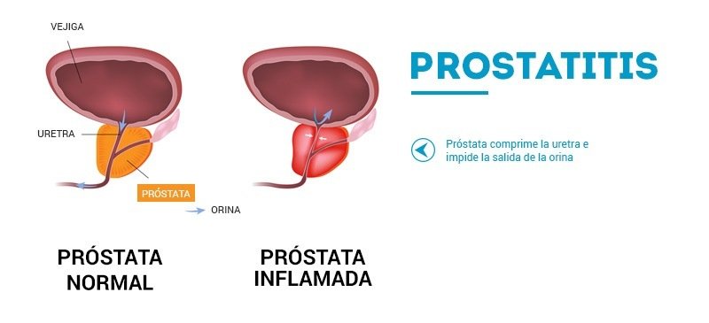 Próstata Inflamada. Todo lo que necesitas saber