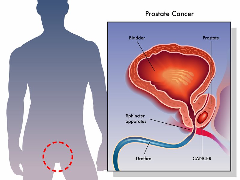 Prostate and ED Problems: Does Prostate Cancer Cause Impotence?