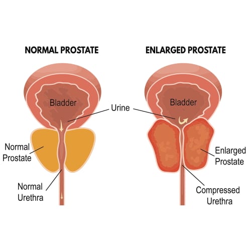 Prostate and Prostatitis