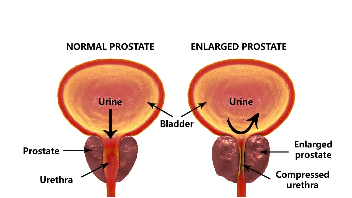Prostate Cancer: A Guide for Aging Men