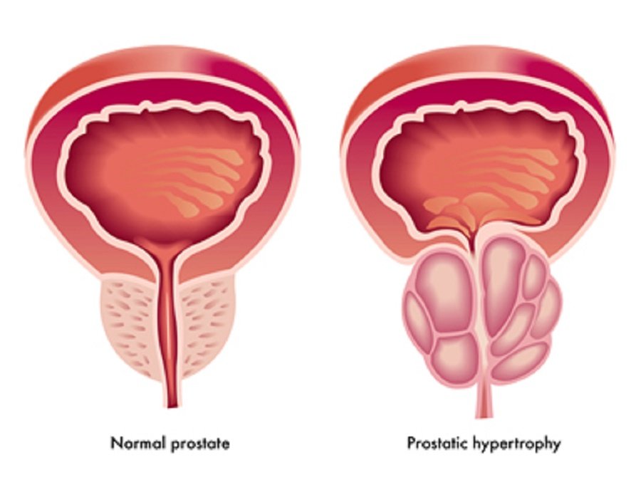 Prostate Cancer, Causes, Symptoms, Diagnosis and Treatment  Mediologiest