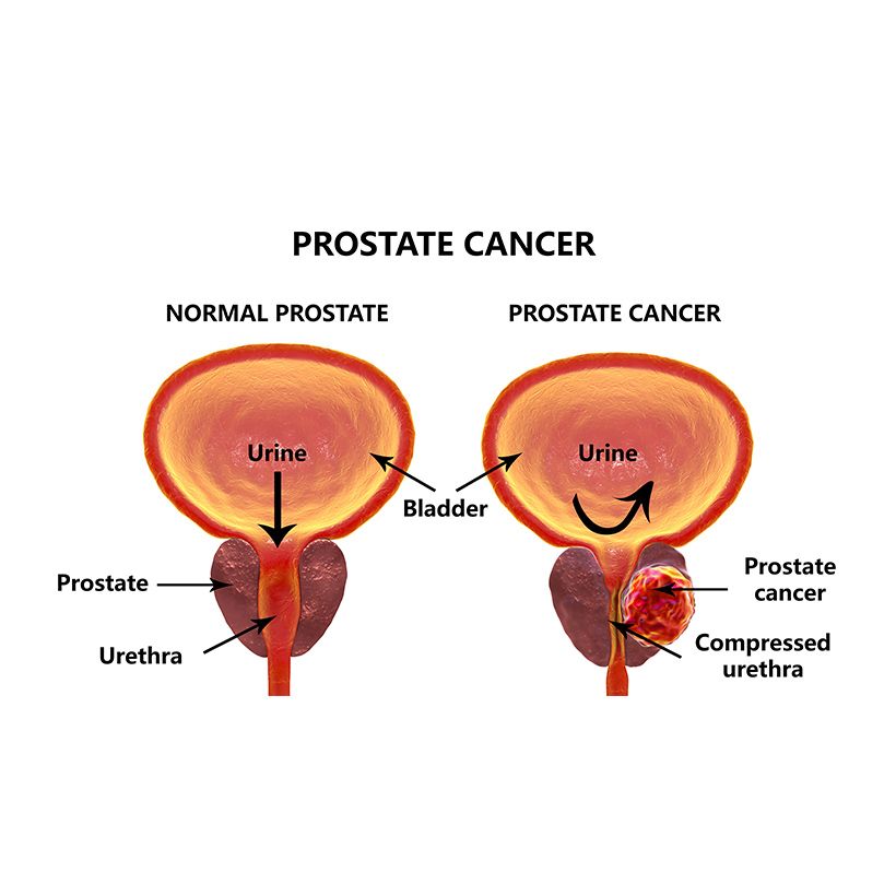 Prostate Cancer Diagnosis And Treatment