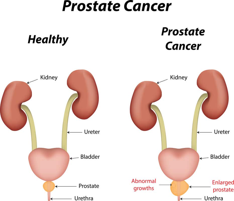 Prostate Cancer Facts Among Black Men