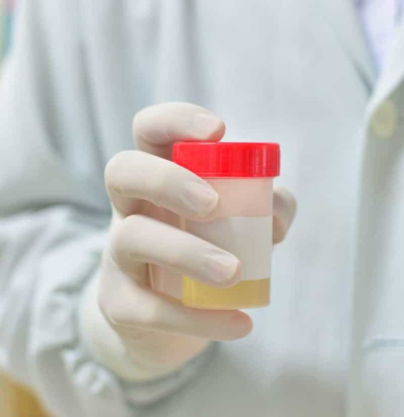 Prostate cancer: Home urine test could