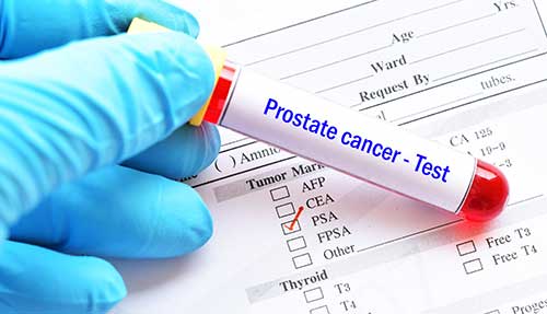 Prostate Cancer Lawyers