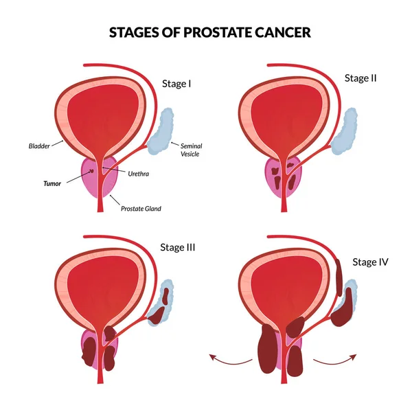 Prostate cancer metastasis  Stock Vector © natsuk77 #9627572
