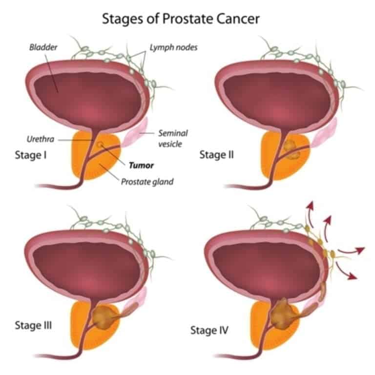 Prostate cancer (overview, symptoms, causes, stages, diagnosis, treatment)