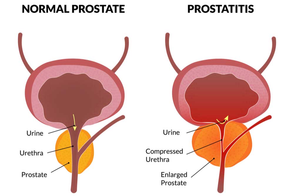 Prostate cancer (overview, symptoms, causes, stages ...