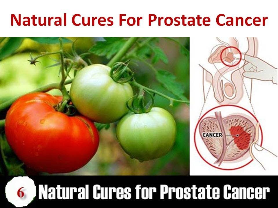 Prostate Cancer &  Prostatitis Treatment with Natural Home ...