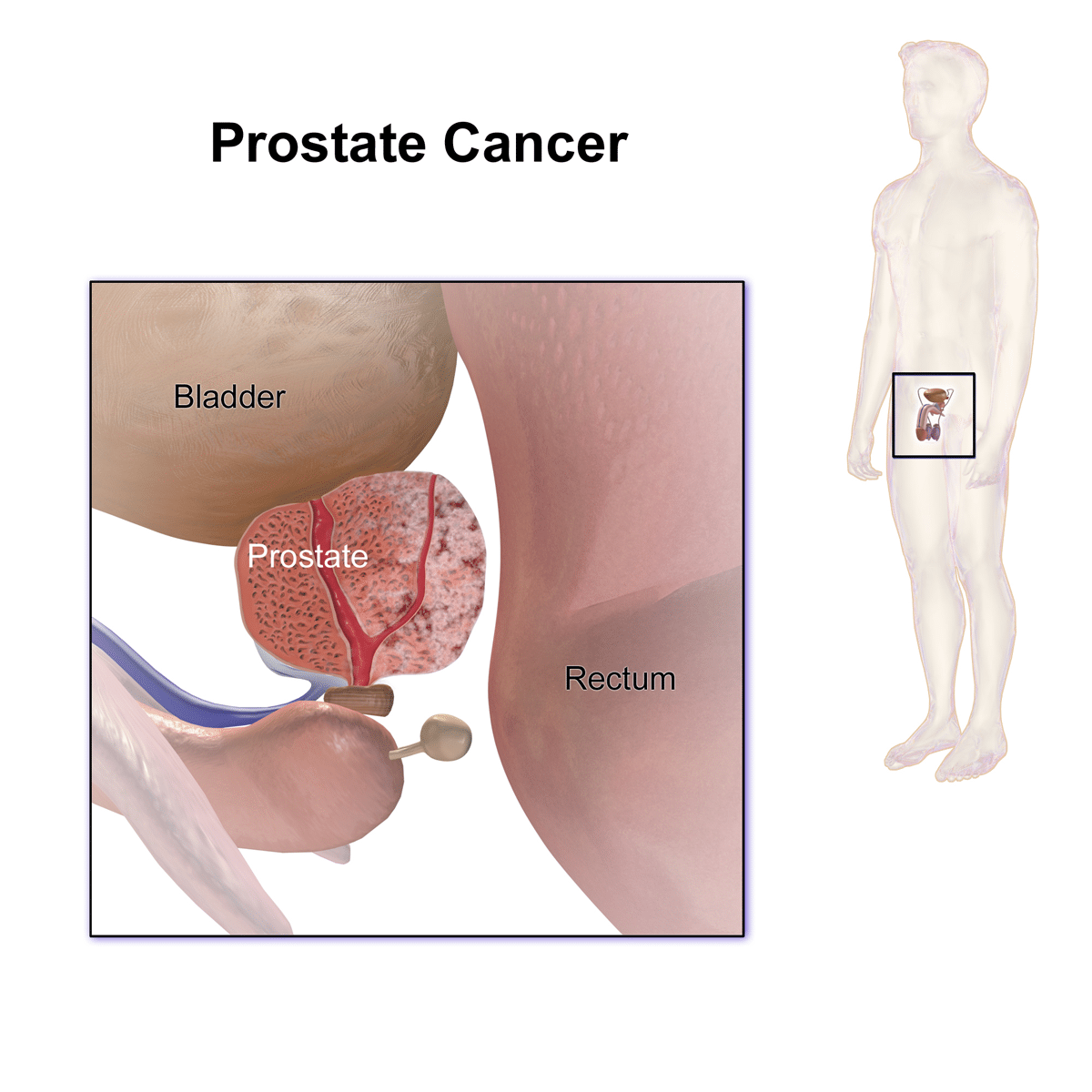 Prostate Cancer Radiation Treatment in Charlotte, NC