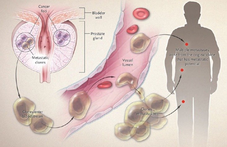 Prostate Cancer Spread Metastatic to Bones Life Expectancy ...