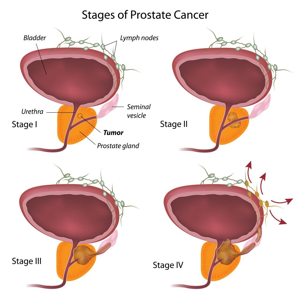 gambar 3 untuk Ciri-ciri Awal Penyakit Kanker Prostat