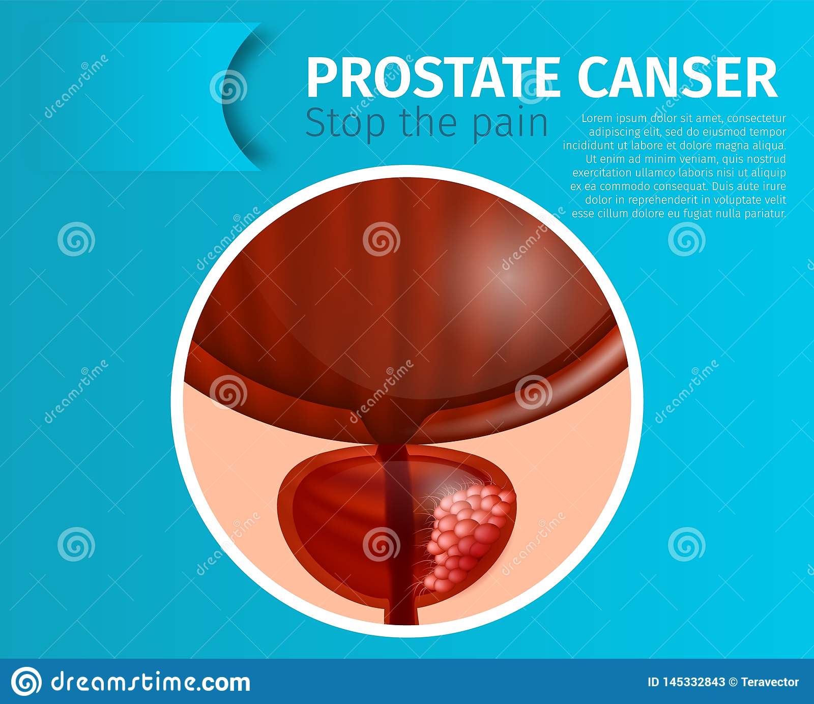 Prostate Cancer. Stop The Pain Urological Banner. Stock Vector ...