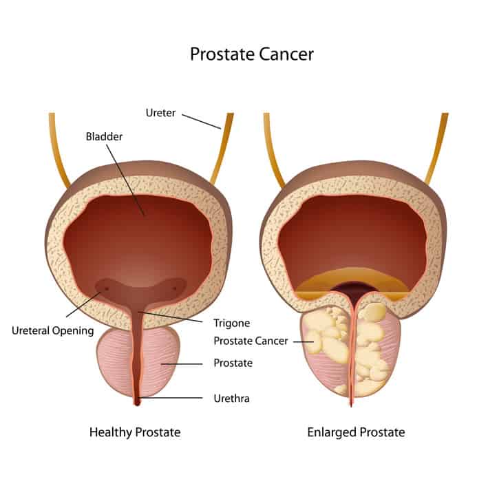 Prostate Cancer: Symptoms and Treatments