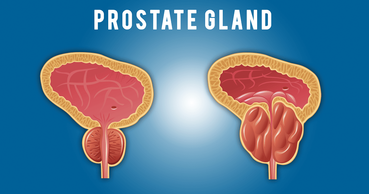 Prostate Cancer Symptoms Singapore : Uterine Prolapse: 10 Uterine ...