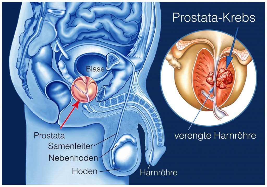 Prostate cancer: these four symptoms, you should go promptly to the ...