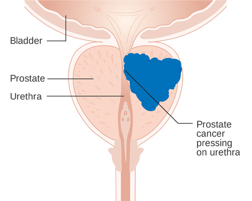 Prostate Cancer Treatment, Doctor, Consultant In Noida ...