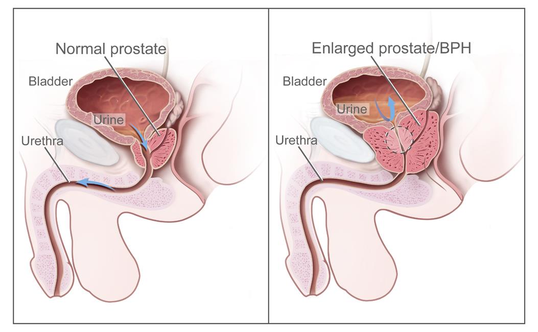 Prostate Cancer Treatment (PDQ®)Patient Version ...