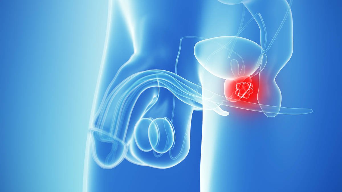 Prostate Cancer: What Are The Symptoms And Who Is At Risk?