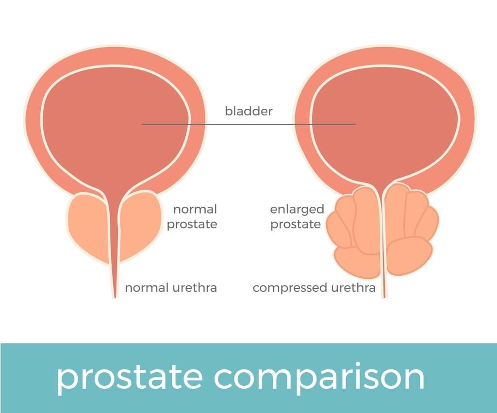 prostate comparison