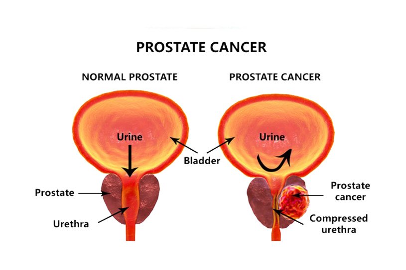 Prostate Conditions: What You Need to Be Aware Of