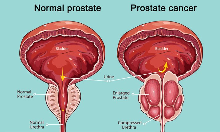 Prostate Gland Removal