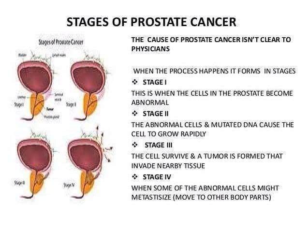 Prostate most cancers treatment For level 4
