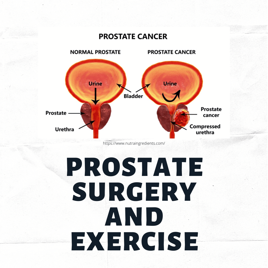 PROSTATE SURGERY AND EXERCISE