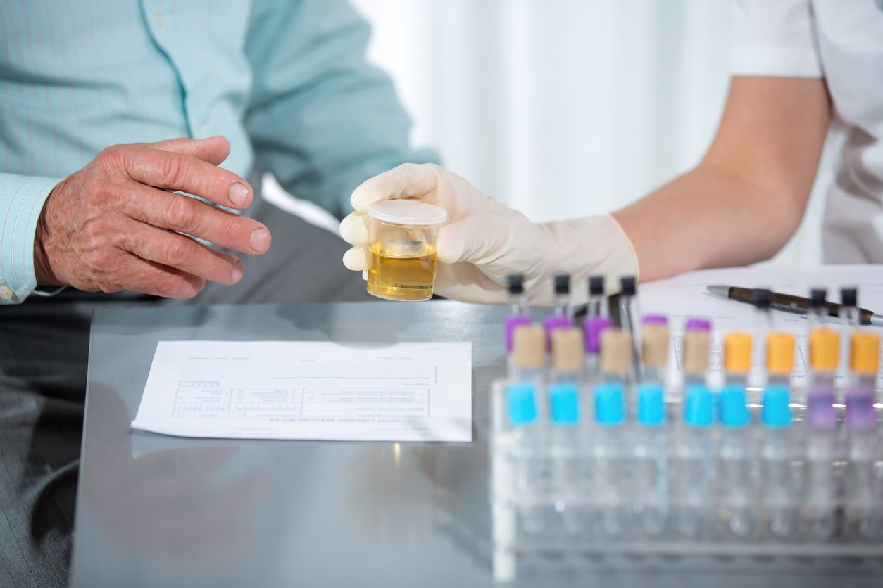 Prostate Urine test to render Biopsies obsolete