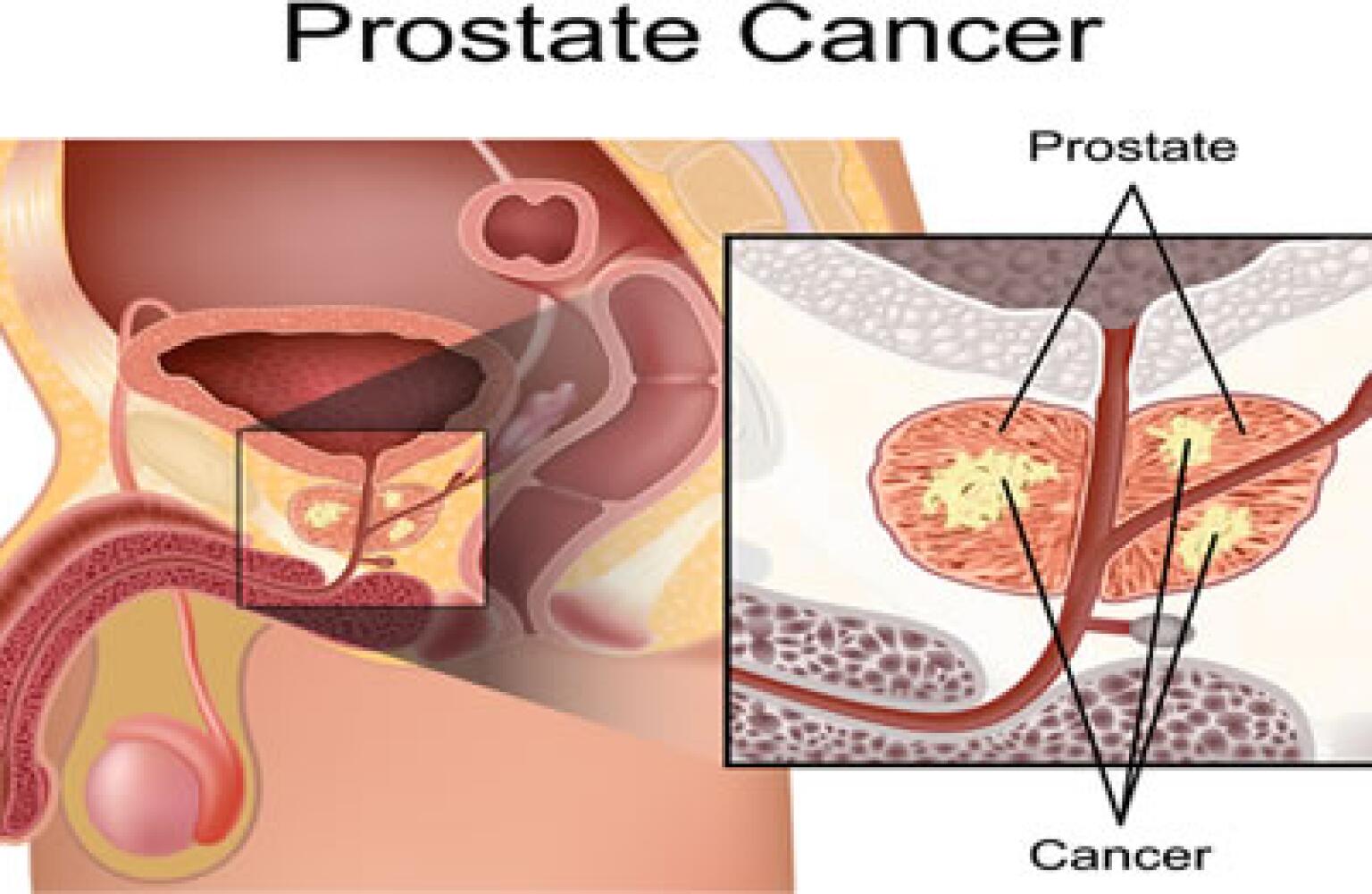 Kann prostatakrebs streuen