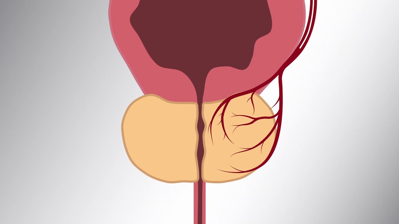 Prostatic Artery Embolization (PAE) Patient Video
