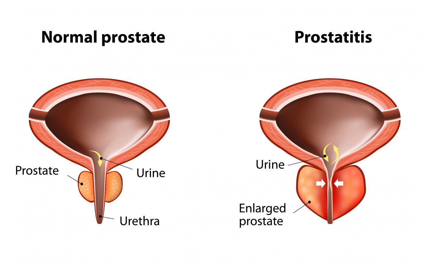 Prostatitis: What You Need to Know