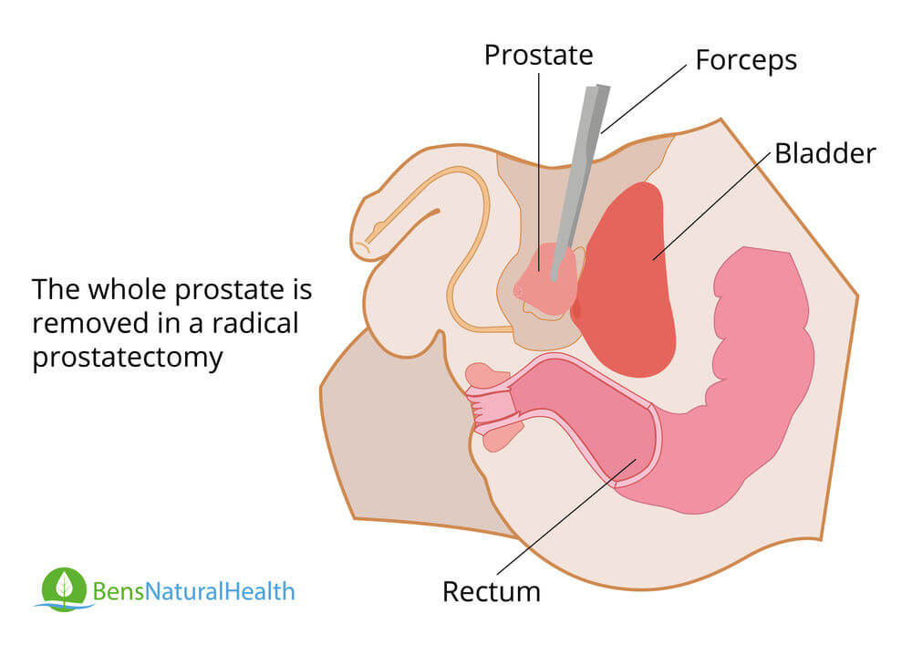Radical Prostatectomy: Surgery To Remove Your Prostate ...