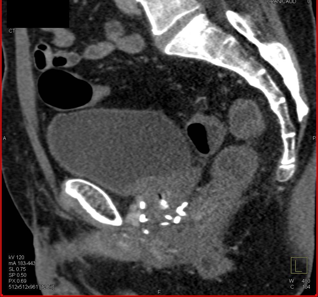 Radioactive Seeds in a Patient with Prostate Cancer