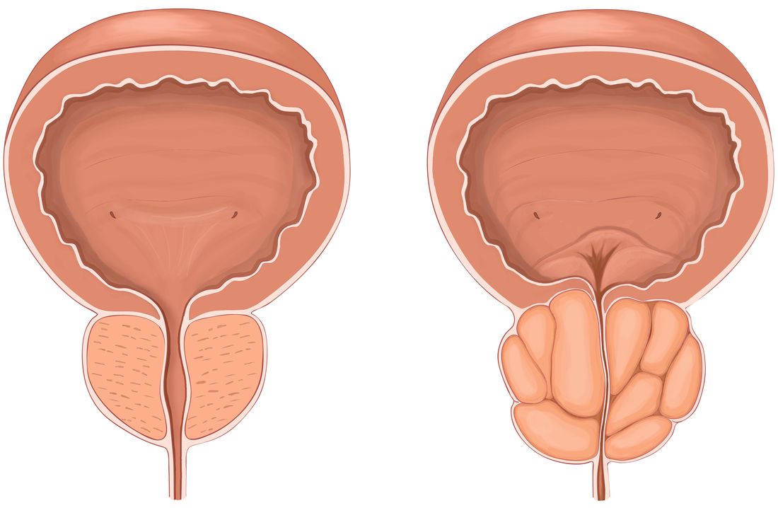 Rezum System for Treating Enlarged Prostate