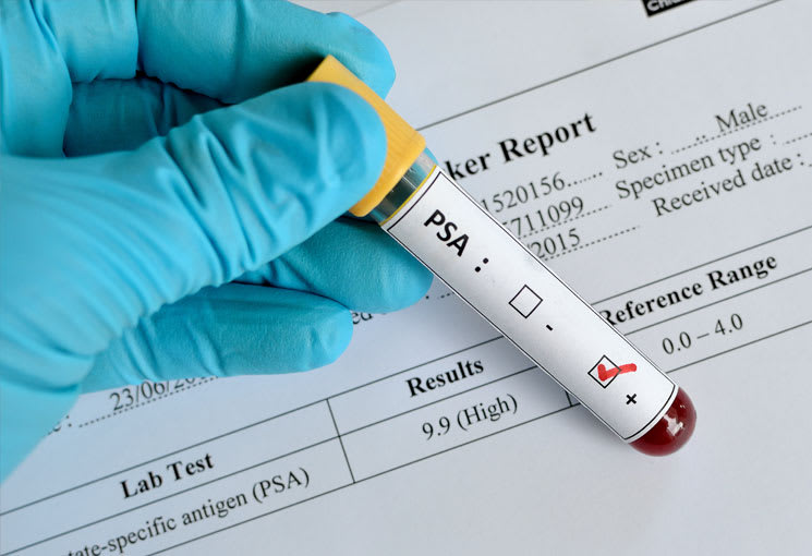 The PSA Test and Screening