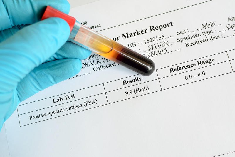 The PSA Test For Prostate Cancer: No Before, Now Maybe ...
