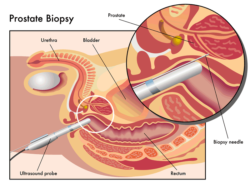 Three types of Prostate Biopsy. How to Choose what