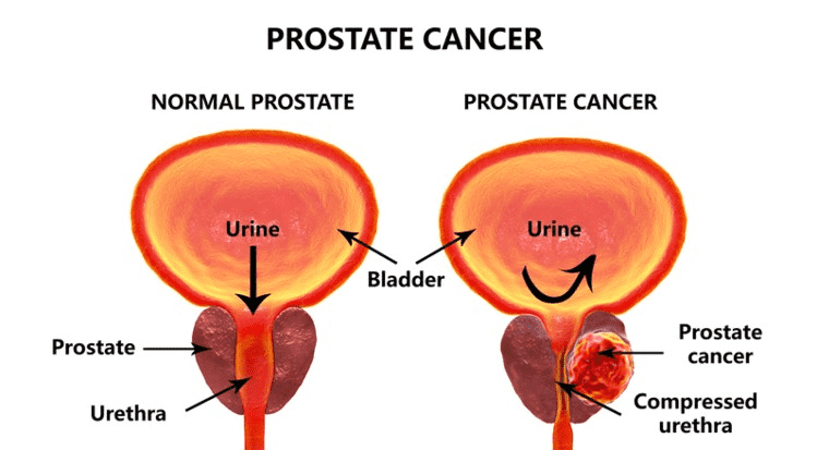 Top 6 Points to Educate Yourself on Prostate Cancer Treatment