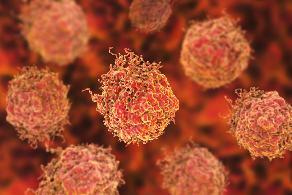 Tumor cell type identified that makes prostate cancer more aggressive