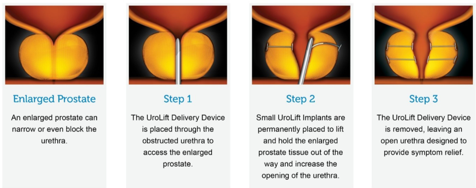UroLift Procedure for BPH (Enlarged Prostate)