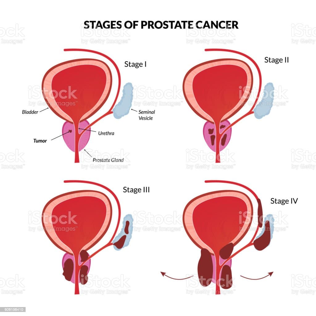 What Are The Four Stages Of Prostate Cancer