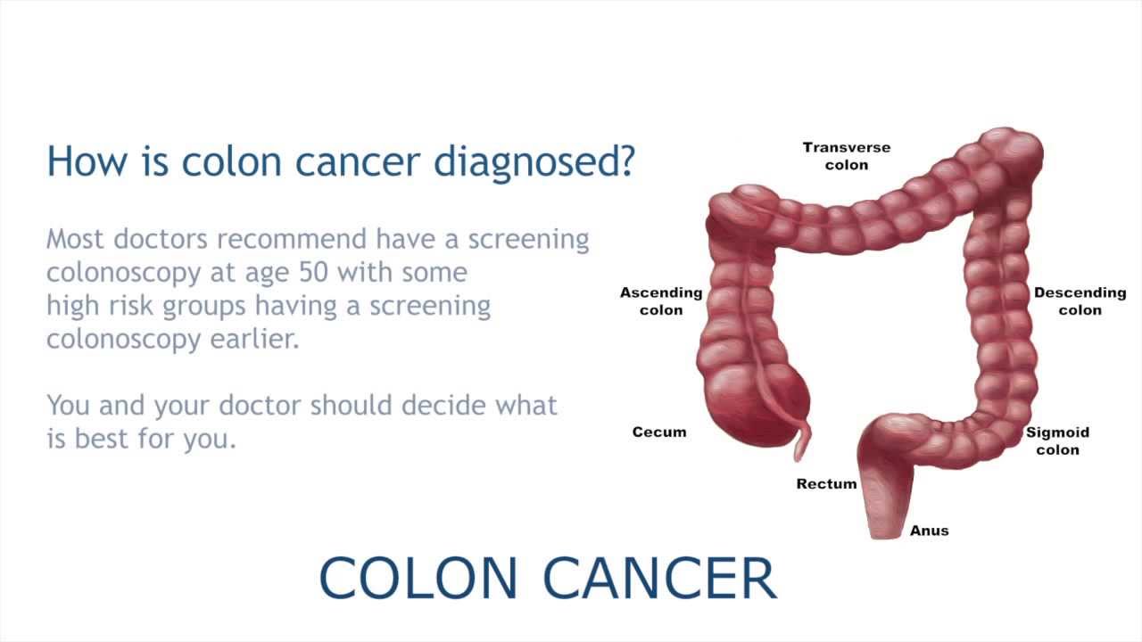 What Are The Signs And Symptoms Of Stage 4 Colon Cancer