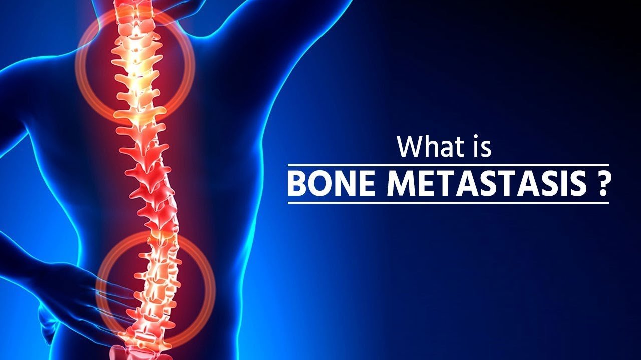 What is bone metastasis