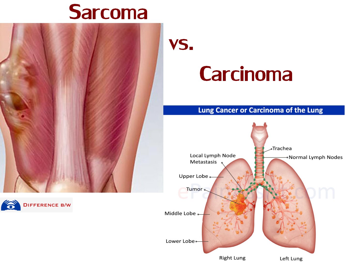 What is Sarcoma vs Carcinoma, Lymphoma, Leukemia Cancer ...
