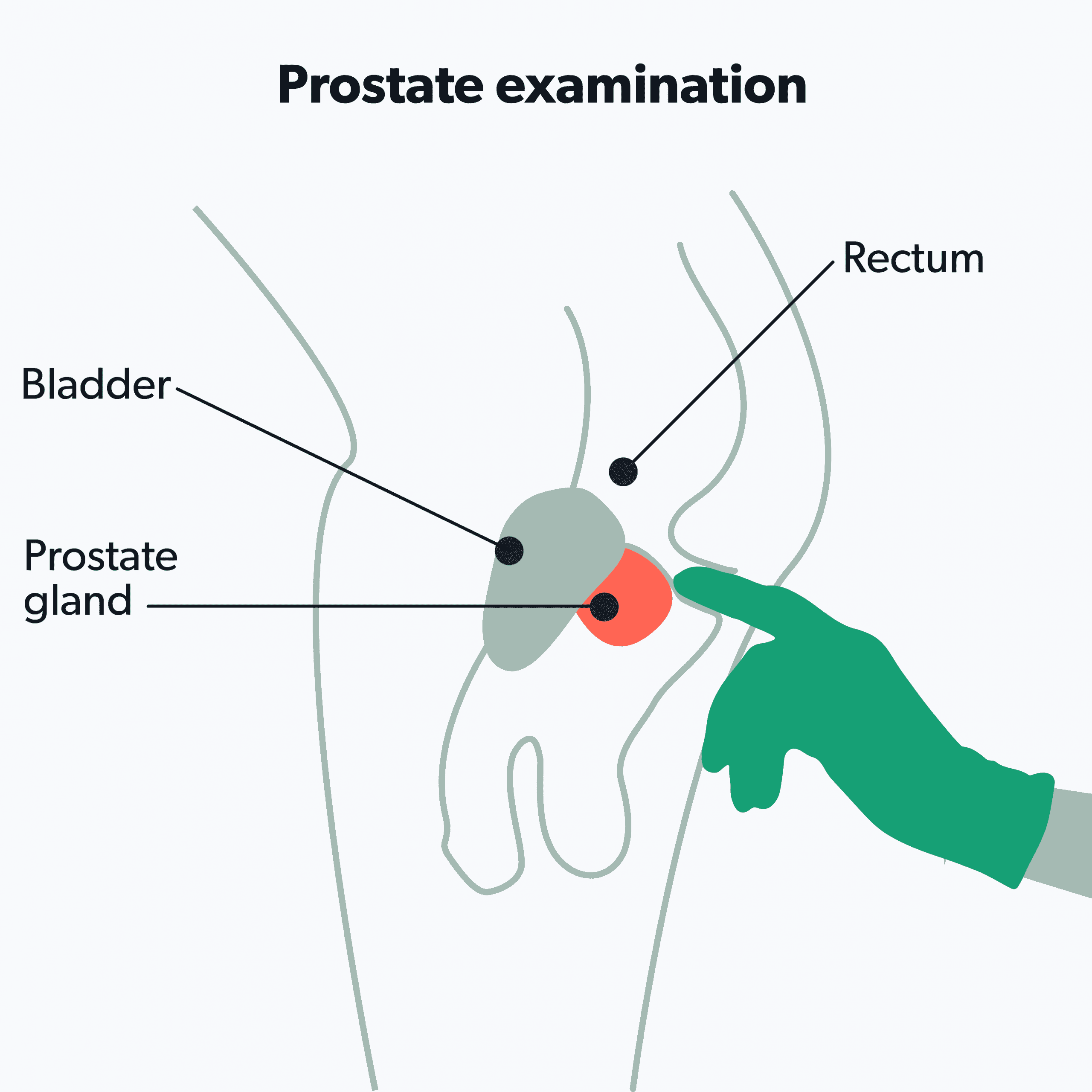 What to Expect During a Prostate Exam